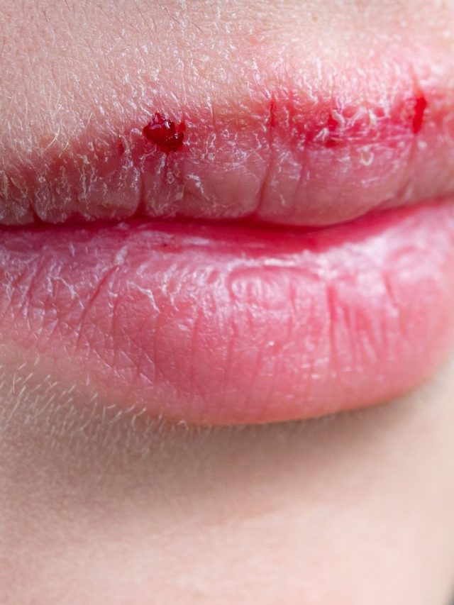 Ways to get rid of chapped lips in winter